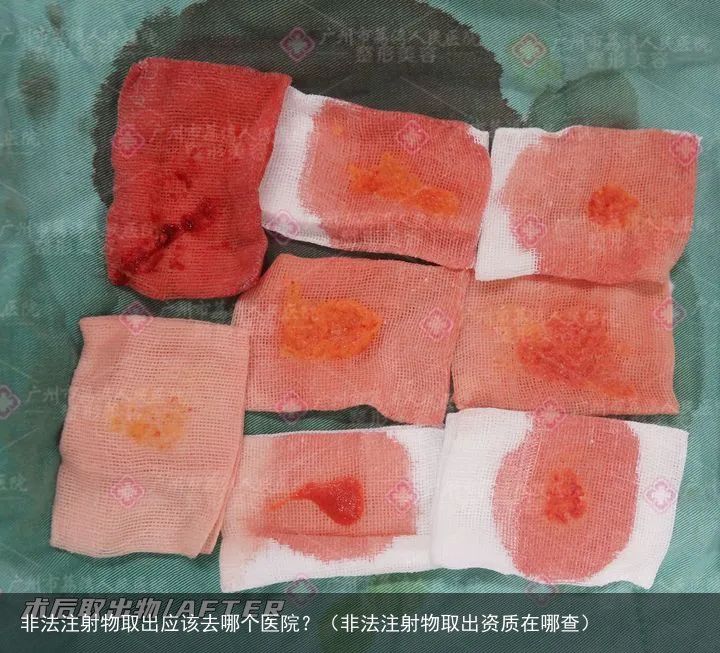 非法注射物取出应该去哪个医院？（非法注射物取出资质在哪查）