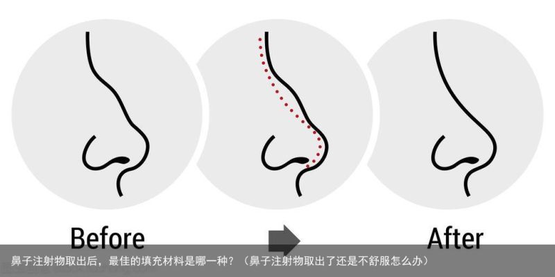 鼻子注射物取出后，最佳的填充材料是哪一种？（鼻子注射物取出了还是不舒服怎么办）