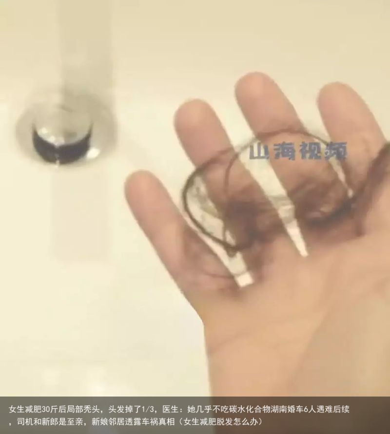 女生减肥30斤后局部秃头，头发掉了1/3，医生：她几乎不吃碳水化合物湖南婚车6人